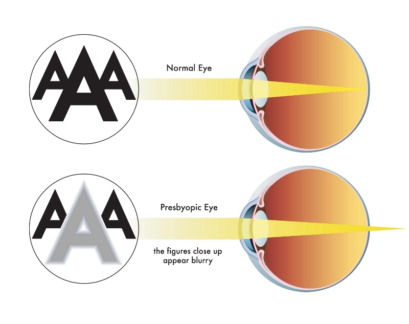 presbyopia graphic